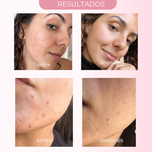 SOS DRYING SUSPENSION – 0 ACNE