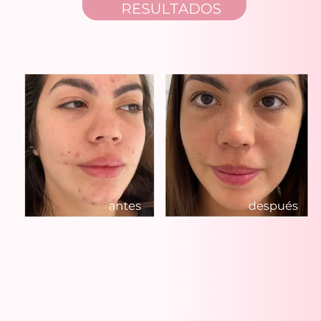 SOS DRYING SUSPENSION – 0 ACNE